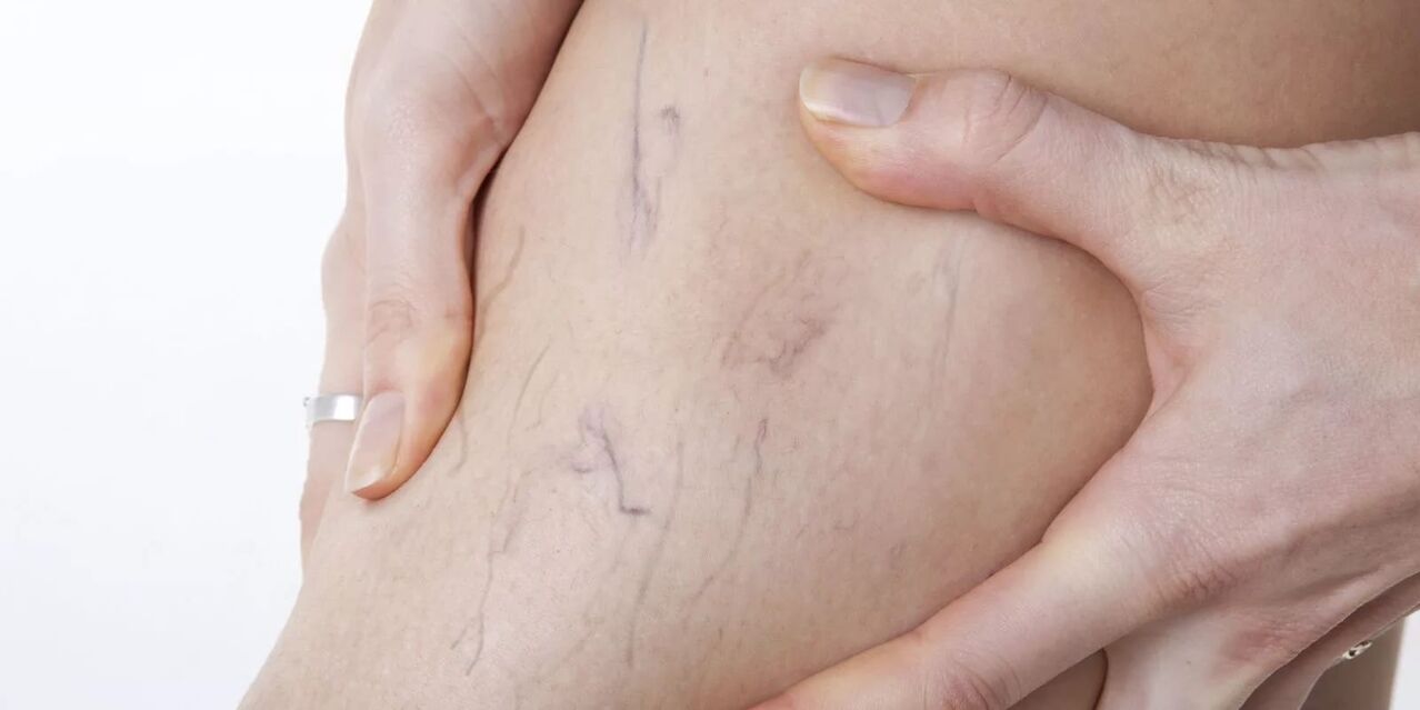 Prima dell'uso della crema di varicone