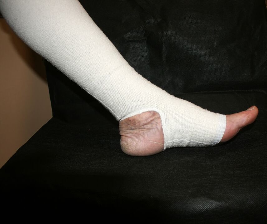 maglieria a compressione per vene varicose